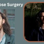 Hozier Nose Surgery